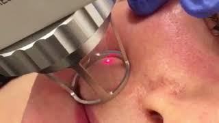 Fractional CO2 Laser Skin Resurfacing