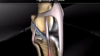 TightRope Cruciate Ligament Surgery using Arthrex Tightrope CCL