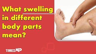 Swelling in different areas of body can indicate underlying health issues | Edema Causes | TimesXP