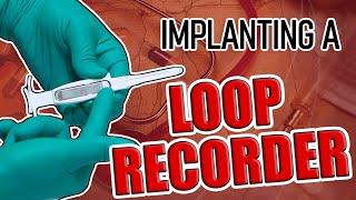 Loop Recorder Implant Procedure