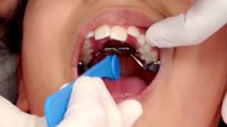 Palate Expander Turning (Activation)