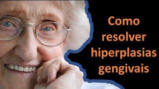 Como resolver hiperplasia gengival | Odontologia | Dra Bianca Rosa