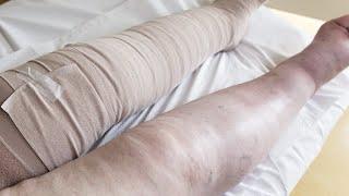Surgical innovations for lymphedema patients | OSUCCC – James