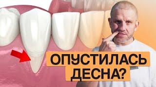 Как ОСТАНОВИТЬ рецессию десны? ЛУЧШИЙ способ