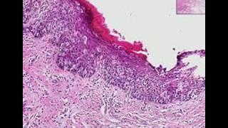 Histopathology Vulva--Paget disease