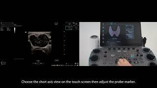 Demonstration of Smart Thyroid on Mindray Resona I9