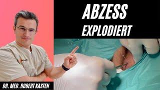 Abszess explodiert während Öffnung, bringt spontane Erleichterung | Dr. Kasten Hautmedizin in Mainz