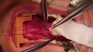 Schwannoma on lateral border of tongue