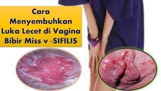 Cara menyembuhkan luka lecet di vagina bibir miss v ~ SIFILIS