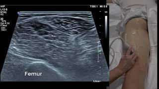 Hamstring Ultrasound 101