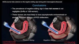 #UOGJournal video abstract on the negative sliding sign during pelvic transvaginal ultrasound
