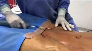  LIPOESCULTURA  ABDOMINAL ETCHING Marcación Abdominal Mujeres (Lipomarcación) ► Dr John Garcia