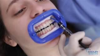 laser teeth whitening | Dentist Beirut Lebanon | Zoom office by philips