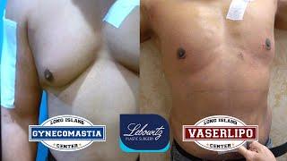 Gynecomastia Surgery: 3 DAYS POST-OP RESULTS ‼️️
