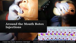 Around the Mouth Rejuvenation.  Botox Injections