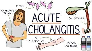 Understanding Acute Cholangitis (Ascending Cholangitis)