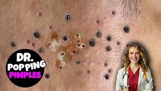 Popping Pimples And Blackheads - 226