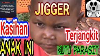 kasihan kaki anak ini :( Pembersihan Jigger atau larva lalat )