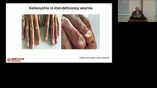 Polycythemia Vera and Myelofibrosis Patients Should Be Treated Early with Interferon - RT Silver, MD