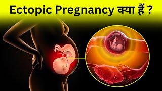 Ectopic Pregnanacy क्या होता हैं ?