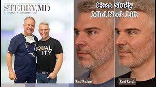 Mini Neck Lift Patient Testimonial