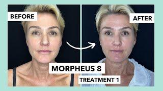Morpheus 8 First Treatment // Non Surgical Facelift // Before and After Treatment 1