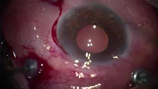 malignant glaucoma after Xen in morbidly obese pt: PPV, iridektomie, Preserflo; no sedation