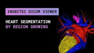 Heart segmentation by region growing in Inobitec DICOM Viewer Pro