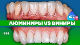 Люминиры VS виниры | Дентал Кейсы от BG #38