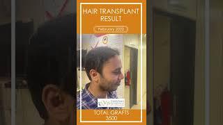 Truth About Hair Transplant | Hair Transplant in Vizianagaram | Vjs Clinics