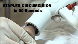 Stapler Circumcision Methods in 30 seconds Video ( Adult Circumcision )