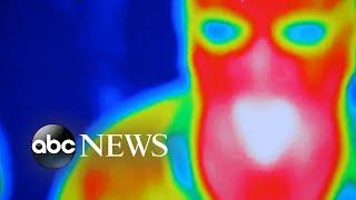 Breast cancer survivor shares cautionary tale about thermography | GMA