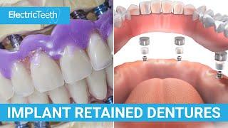 Implant retained dentures explained