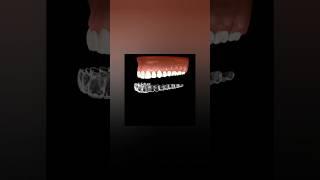 Teeth bleaching at home with tray technique: The Animation