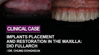 Implants placement and restoration in the maxilla: DIO FullArch by Dr. Chung Dongkeun