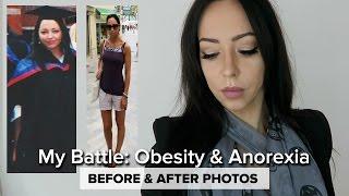 MY STORY | Anorexia & Obesity Journey