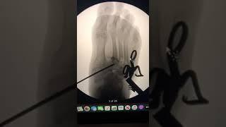 Lisfranc Osteotomy w/Correction & Stabilization Via Circular External Fixation (Dr. Gaurav Vajaria)