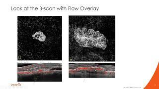 OCT Angiography: Age Related Macular Degeneration with Dr. Julie Rodman