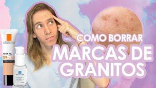 COMO BORRAR MARCAS DE ACNE de manera rápida y segura