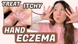 How to Treat Hand Eczema ️ Dr. Joyce Dermatologist