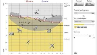 mild hearing loss simulation