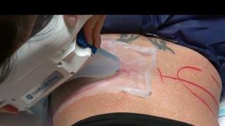 CoolSculpting Fat Freezing for Flanks & Lower Abdomen - Dr Gidon Frame