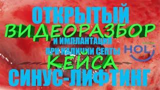 Открытый синус-лифтинг и имплантация при наличии септы. ВИДЕОРАЗБОР КЕЙСА