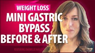 Mini Gastric Bypass Before and After - More Things I Wish I Knew