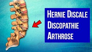 Hernie discale, Discopathie, Arthrose : Mieux comprendre son mal de DOS