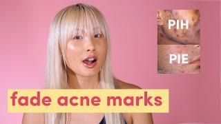 Fade acne marks! Post inflammatory hyperpigmentation & post inflammatory erythema  | PIH & PIE