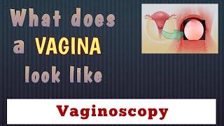 Vaginoscopy