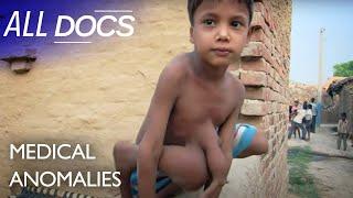 The 8 Limbed Boy | S01 E02 | Extraordinary People Documentary | All Documentary