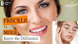 What's the difference between a freckle and a mole? - Dr. Nischal K  | Doctors' Circle