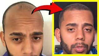 Crazy Minoxidil 5% Hair Growth in 2.5 Months Fails after 2.5 YEARS!? Here's WHY!